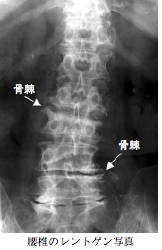 腰椎のレントゲン写真