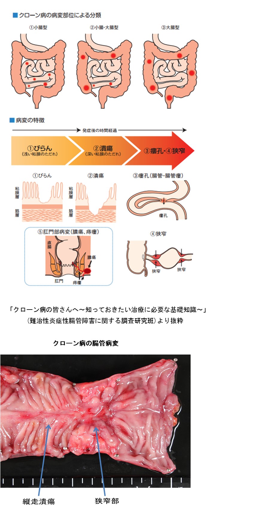 クローン病の診療ガイド [単行本] 日本炎症性腸疾患協会