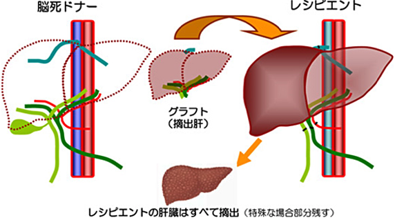 図1：脳死肝移植