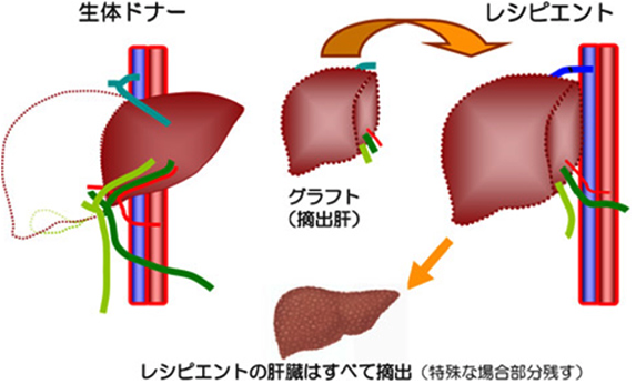 図2：生体部分肝移植