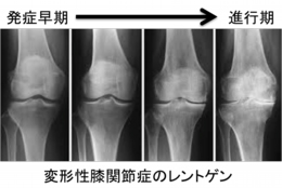 変形性膝関節症のレントゲン