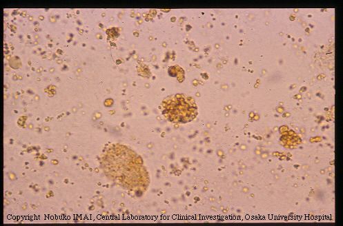 Hemosiderin Granules And Renal Tubular Epithelial Cells With Hemosiderin Granules And Renal Tubular Epithelial Cells With