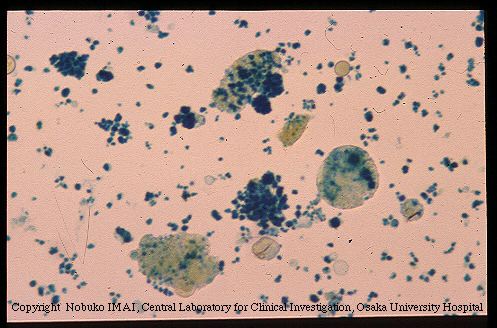 Hemosiderin Granules And Renal Tubular Epithelial Cells With Hemosiderin Granules And Renal Tubular Epithelial Cells With