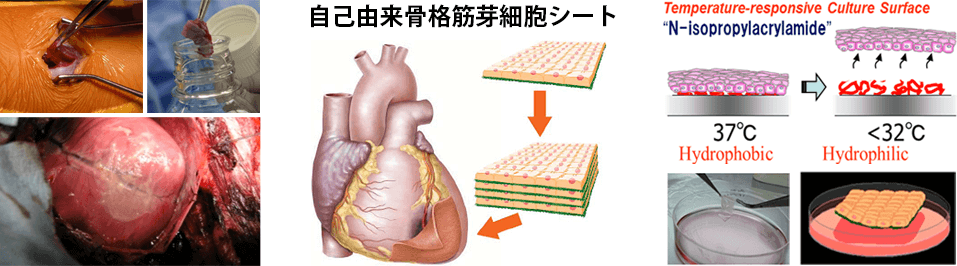 重症心不全に対する筋芽細胞シート