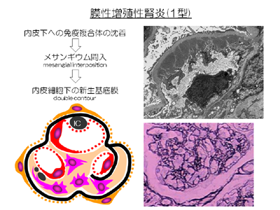 膜性増殖性糸球体腎炎(1型)