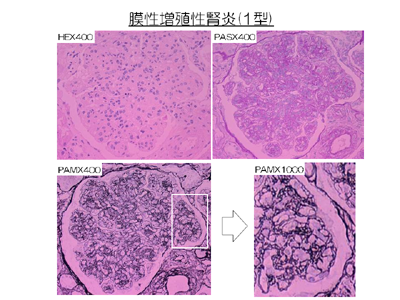 膜性増殖性糸球体腎炎(1型)