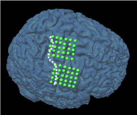図1：皮質脳波計測
