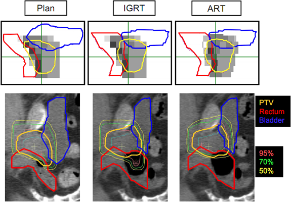 On-line adaptive radiotherapy(ART)における治療計画修正の最適化