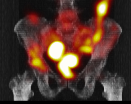 骨盤SPECT/CT画像(Ra-223)