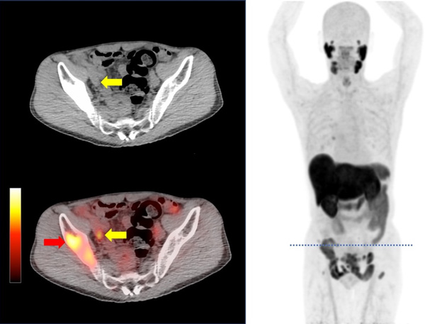 前立腺がんでのF-18 PSMA-1007 PET/CT画像 全身PET(右)の点線の断面をPET/CT(左)に表示。<br>右腸骨転移(赤矢印)に加えて、従来の検査では検出が難しい小さなリンパ節転移(黄矢印)が描出されている。