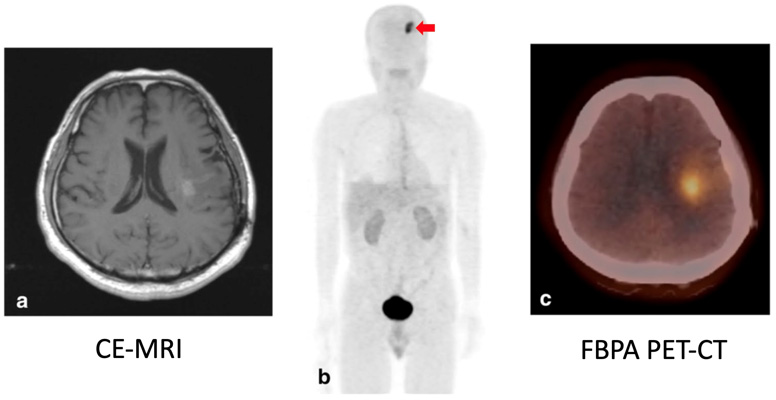 FBPA-PET in recurrent brain tumor