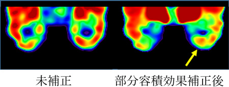 AMPA受容体 PETの部分容積効果補正 左側頭葉てんかん