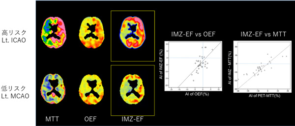 IMZ SPECTによる脳代謝予備能の推定