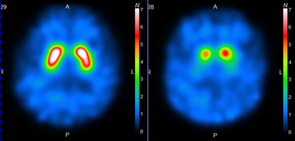 脳ドパミントランスポーターSPECT