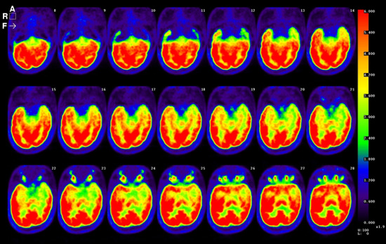 18F-FDG PET (脳)