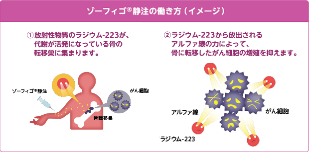 ゾーフィゴ治療：前立腺癌骨転移の治療